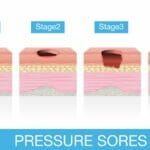 What are the 6 Main Classifications Stages of Pressure Injuries?